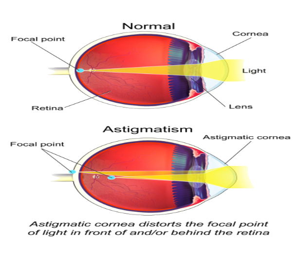Astigmatic cornea distorts the focal point of the light in front or behind the Retina