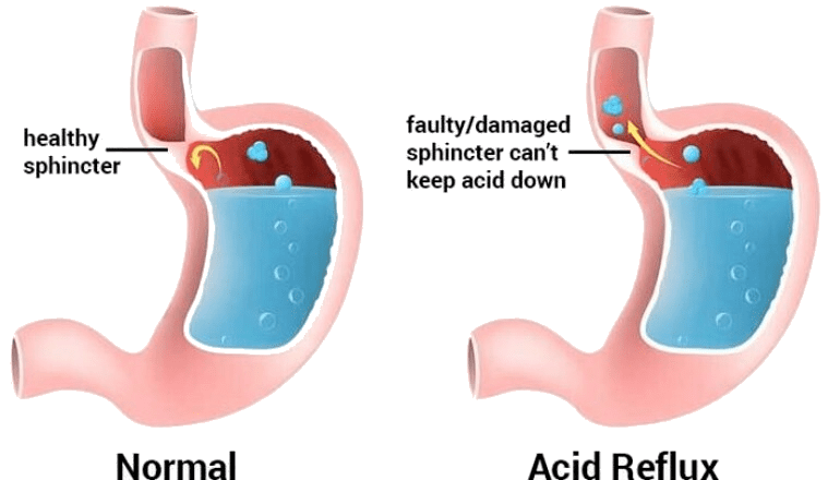 GERD is brought on by the stomach's contents often moving back into the tube connecting the mouth and stomach.

