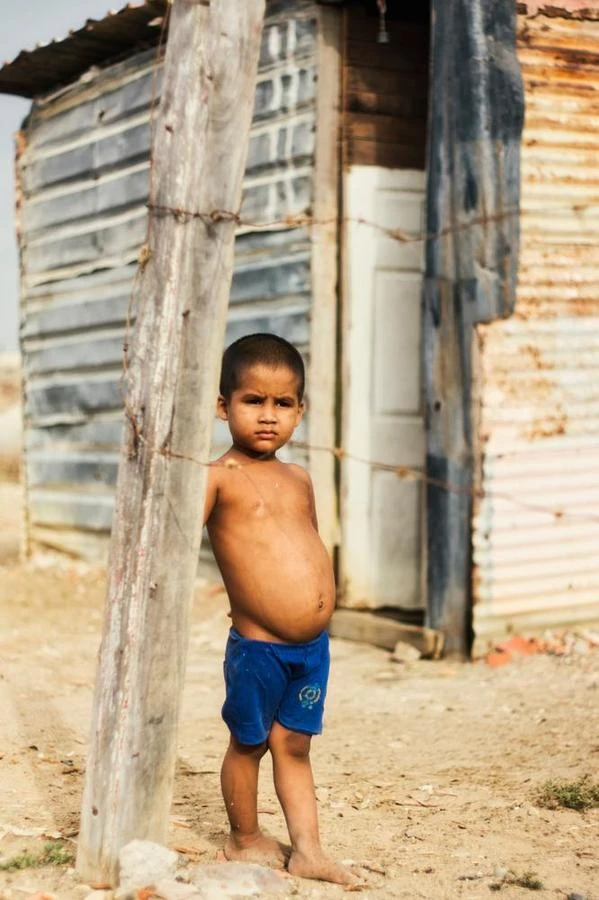 Child suffering from malnutrition condition with swollen belly