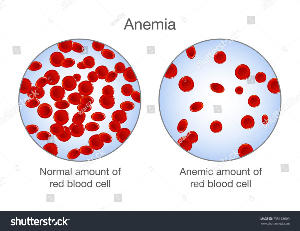 Anemia: Symptoms, Causes, Types, Treatment & Prevention - 88Guru